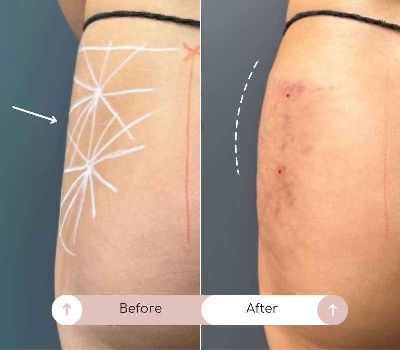 sculptra body before after